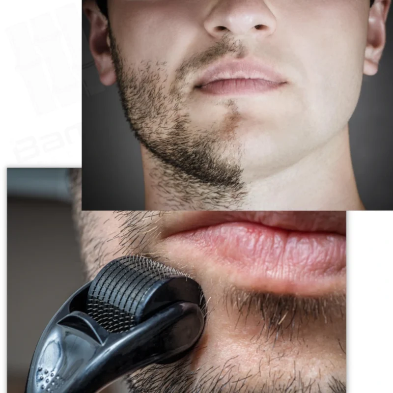 Rodillo Dermaroller de Titanio Negro 1.5mm 540 agujas - Imagen 4